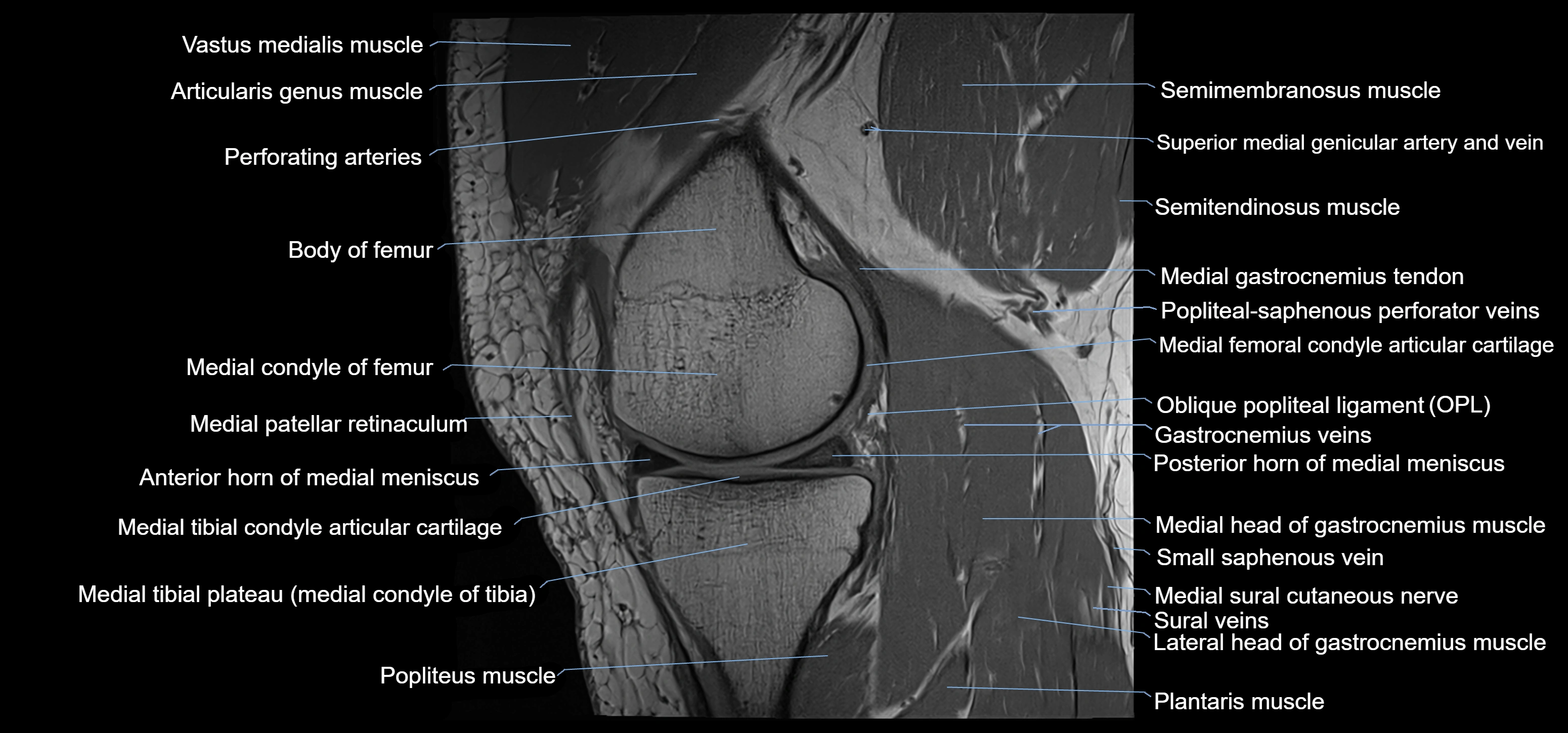 MRI knee sagittal cross sectional anatomy labelled 3T radiology image-00017.webp